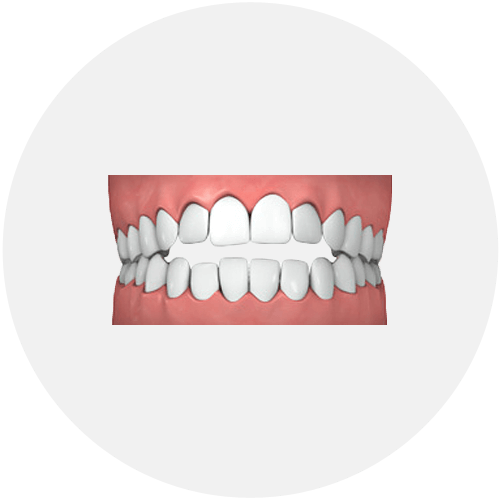 Open Bite